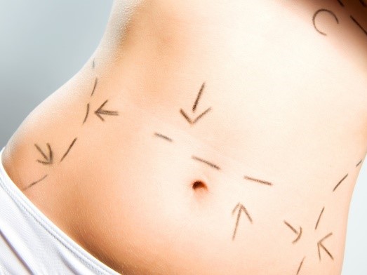 Phẫu thuật thẩm mỹ toàn thân 