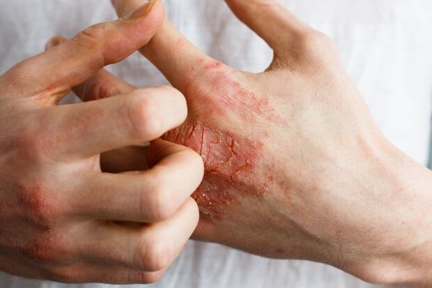 Vết thương do gãi (eczema)